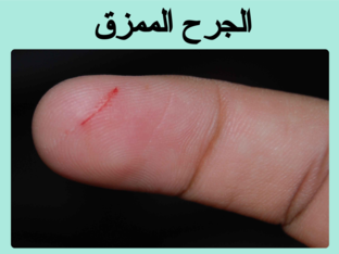 انواع الجروح by Amal Mhlwes